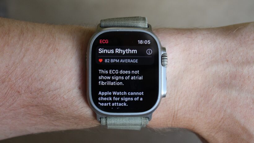sinus-rhythm-apple-watch